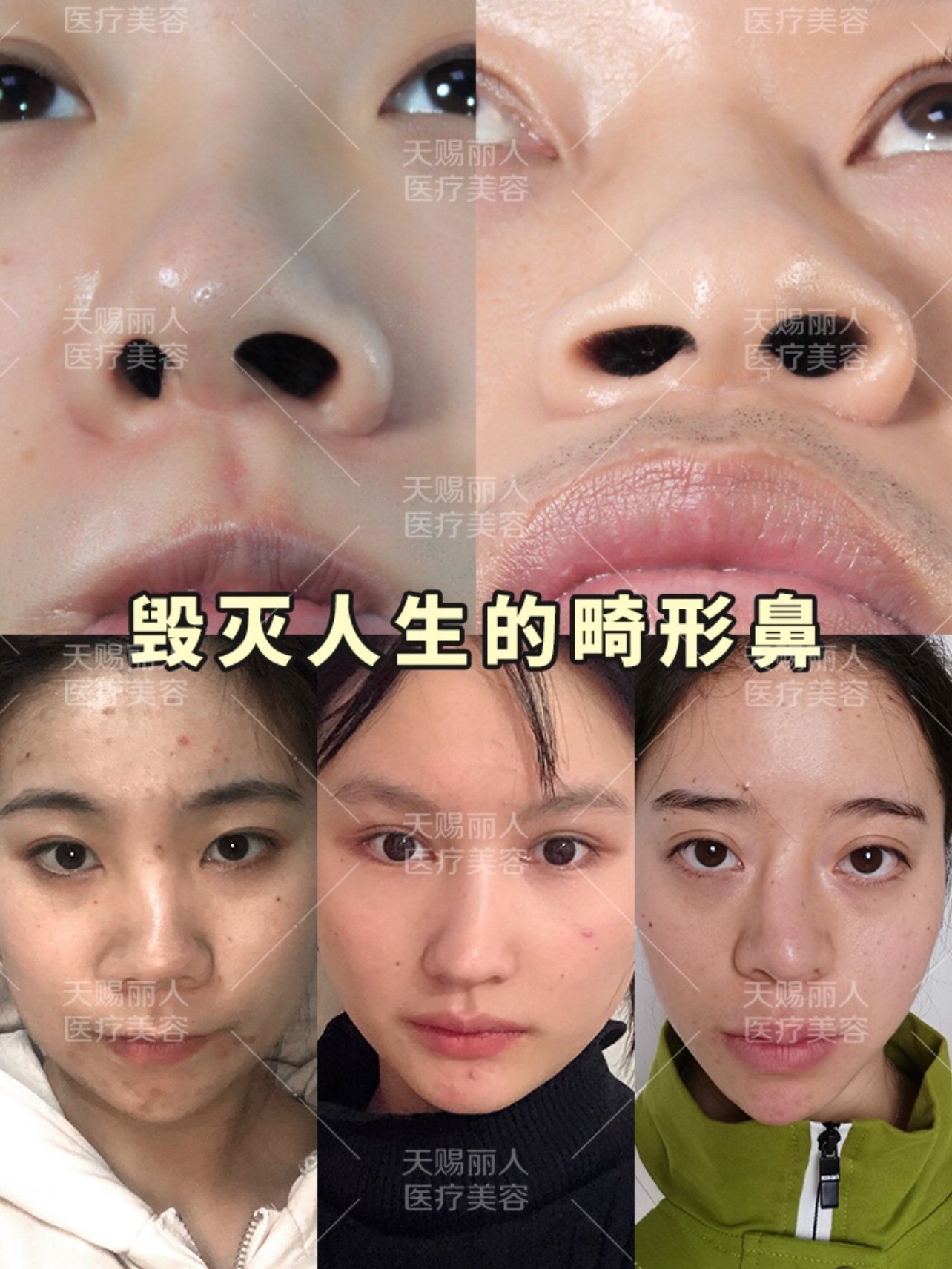 统一鼻整形审美的鼻子长什么样?鼻畸形篇