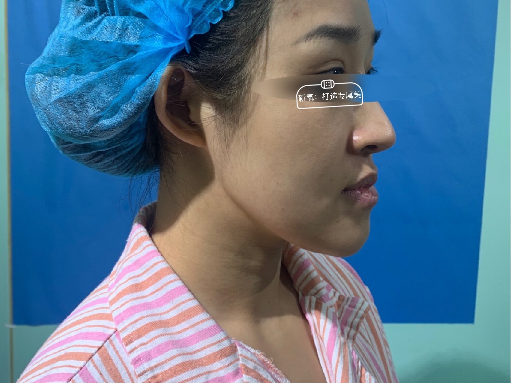 这是一位98年的小妹妹,先天性的地包天,可以从第一张照片看到,整个