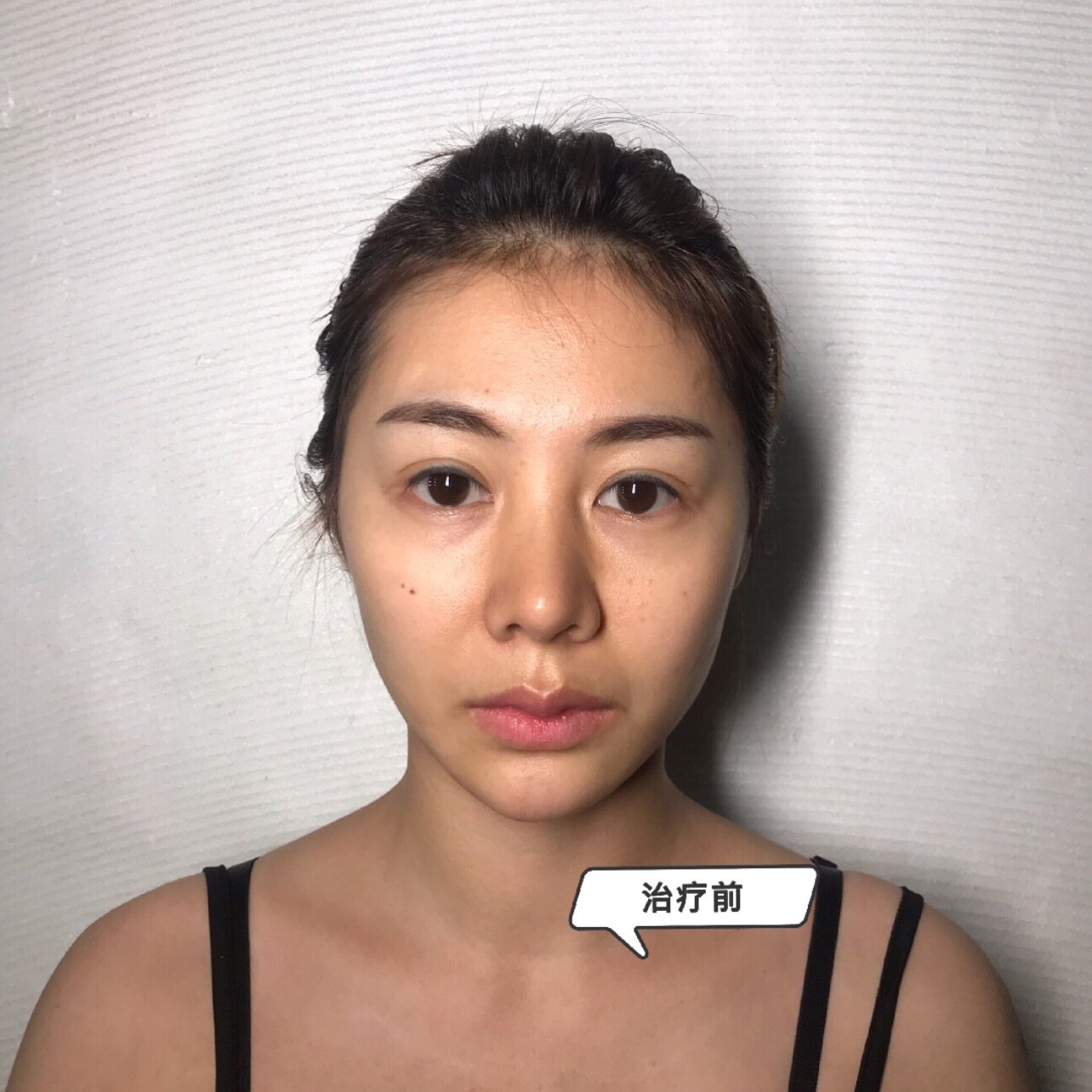 7915【治疗前情况】 78肤色暗沉,发黄,肤色不均,脸_圈子-新氧