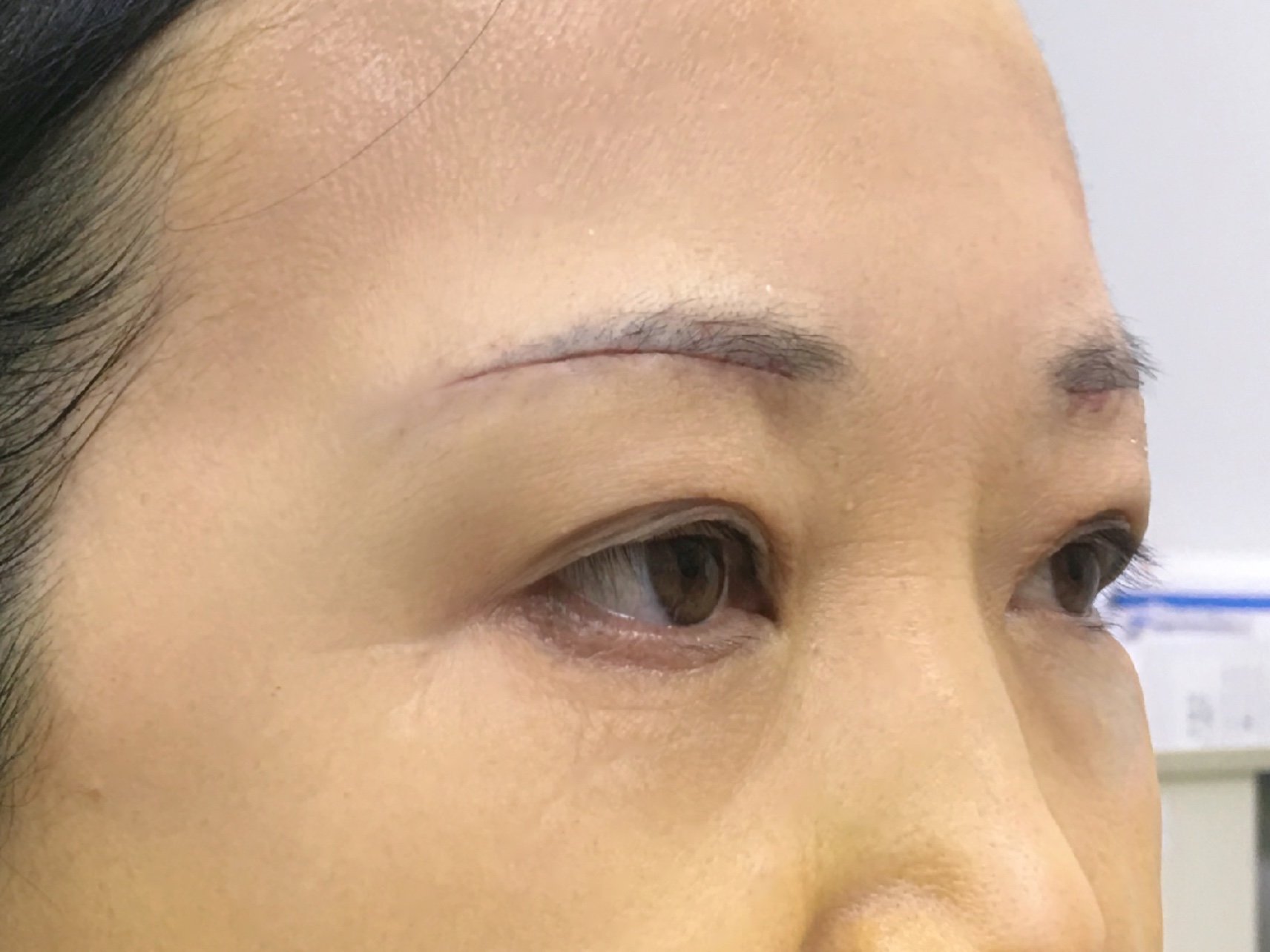 免拆线提眉案例分享#整形医生案例大赏