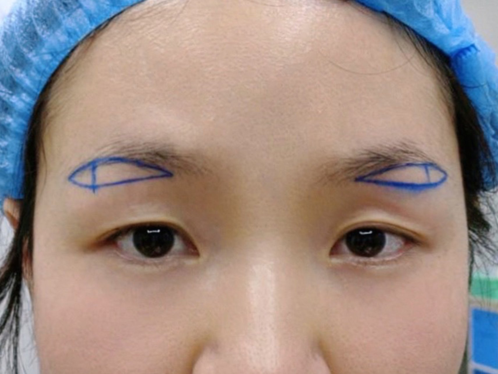 免拆线提眉案例分享整形医生案例大赏