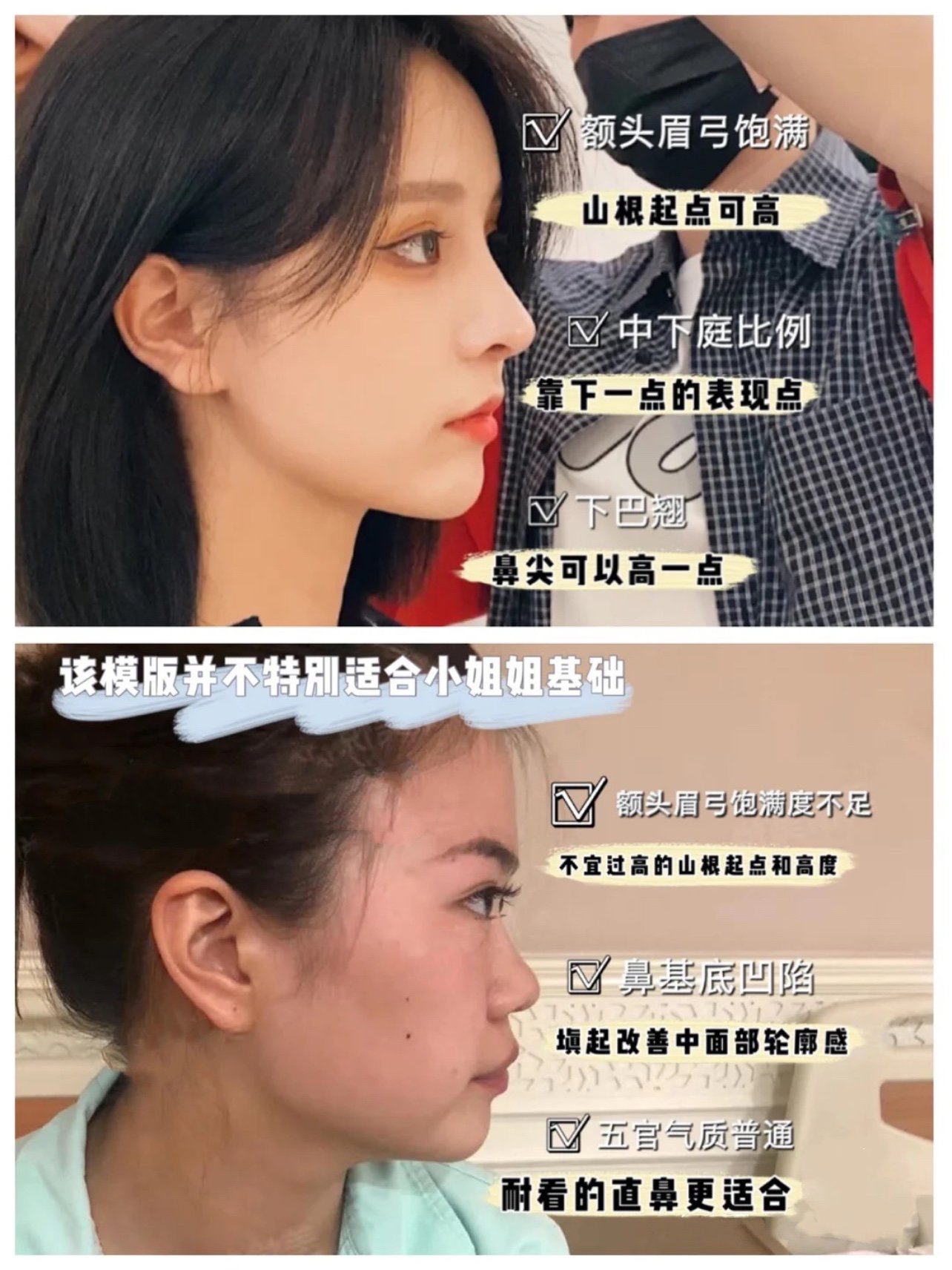 隆鼻分享之山根篇