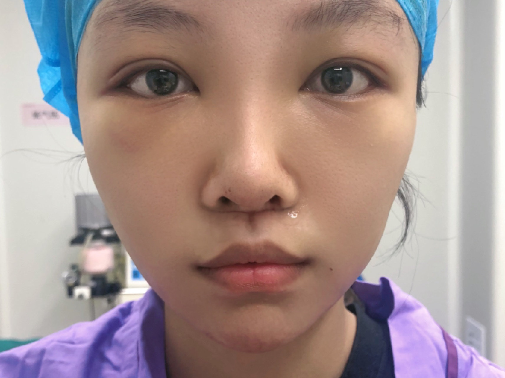 幼态短人中案例分享人中缩短