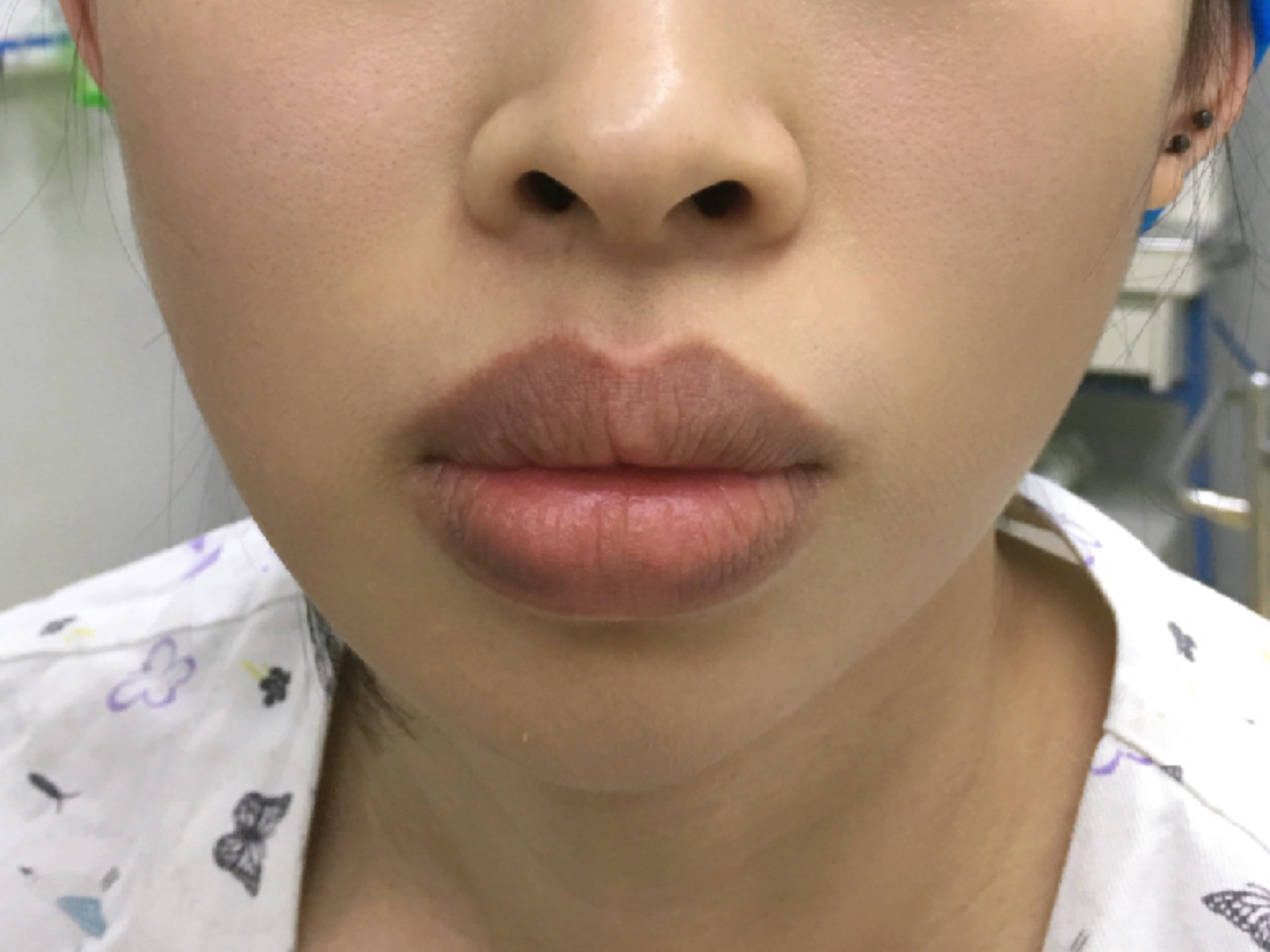 元宝唇唇综合案例分享#元宝唇