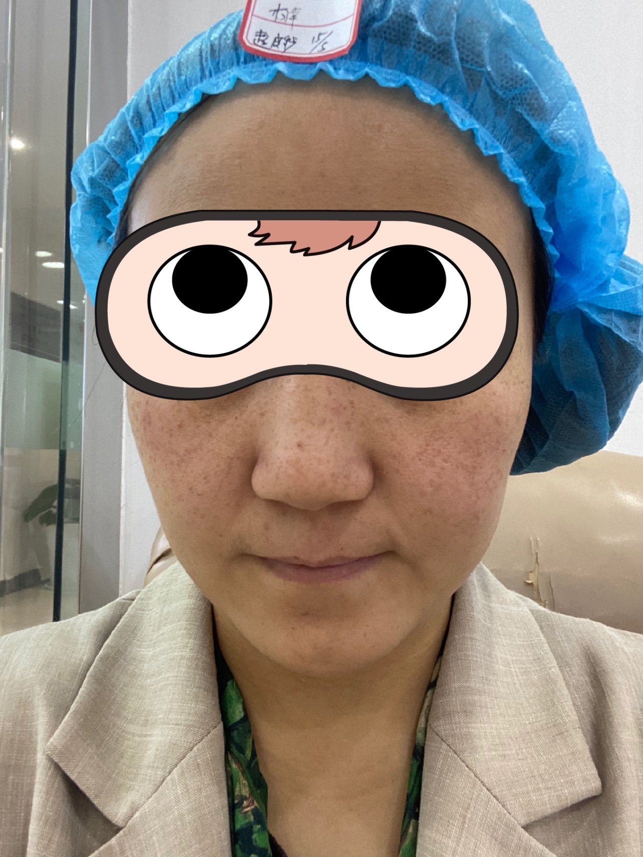 做完超皮秒第一天超皮秒祛斑