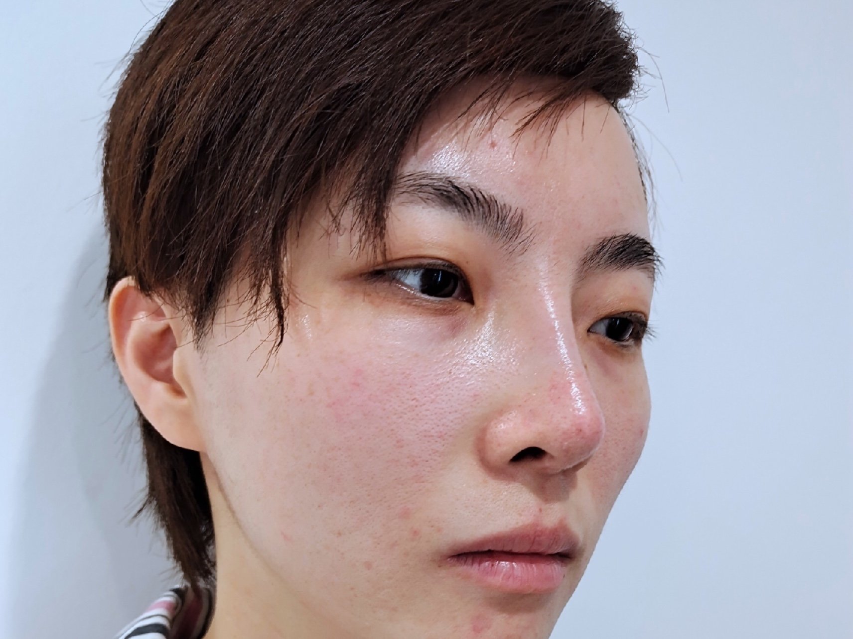 刚打完水光,我的脸就没那么油了,脸上的痘痘也有些好_圈子-新氧美容