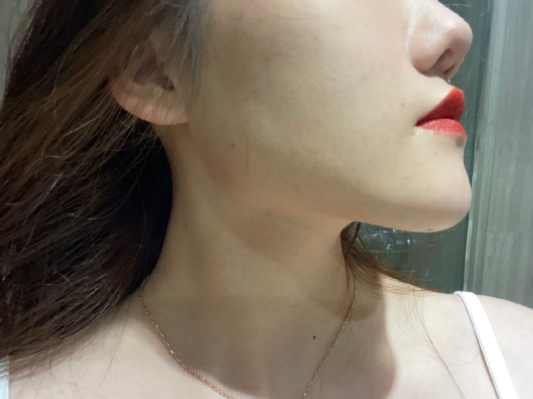 术后效果明显改善了皮肤下垂,下颚线更加明显.