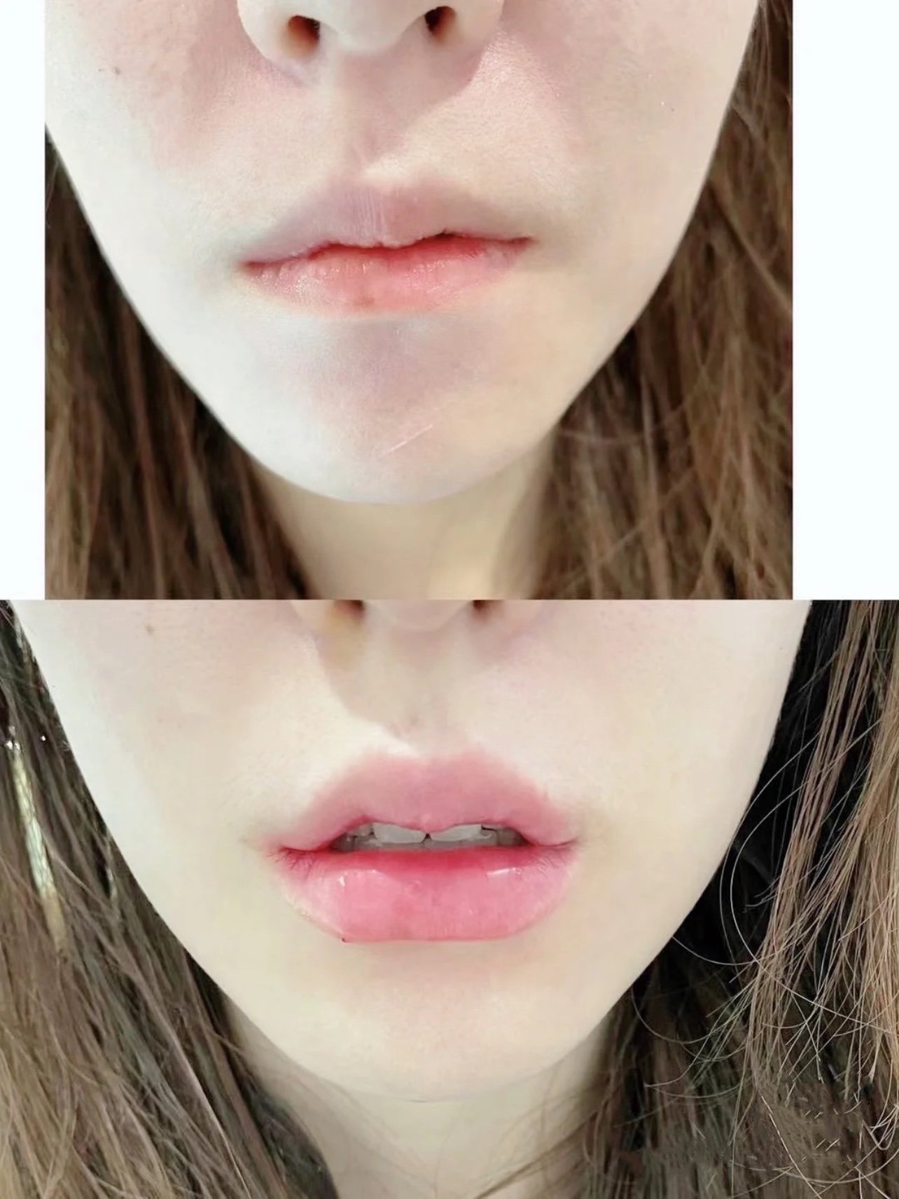 小薄嘴第一次打玻尿酸丰唇啦