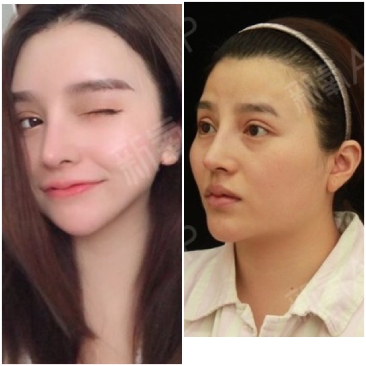 假体丰额头项目术后第15天