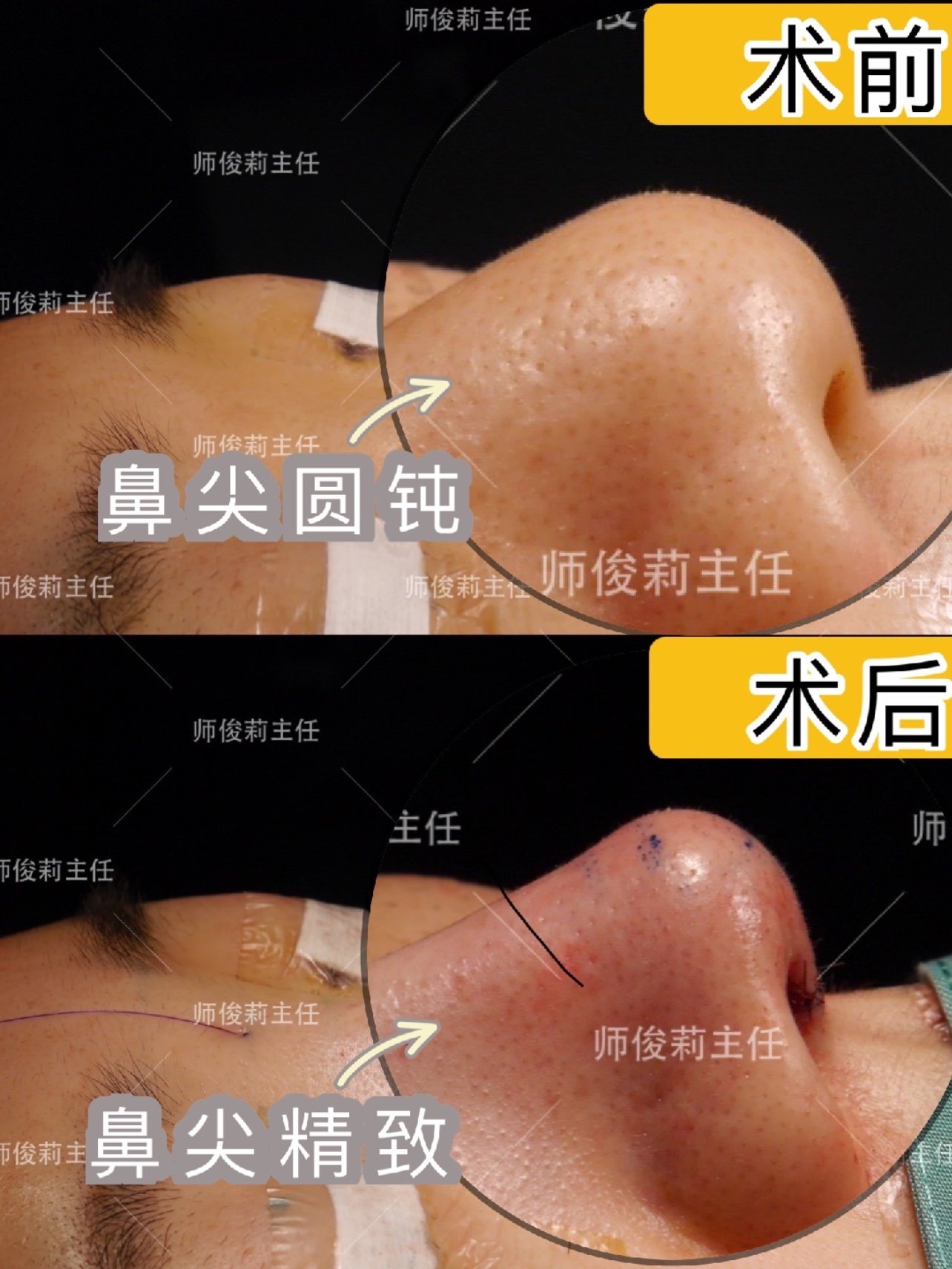 早上分享了美容缝合技术,下午"妈生款"美鼻就安排上_圈子-新氧美容