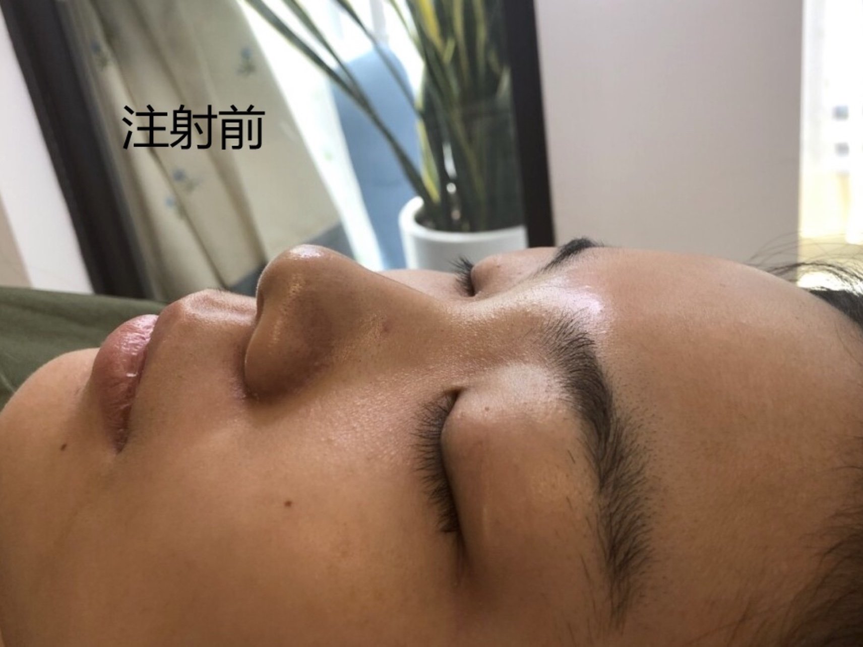 玻尿酸注射隆鼻