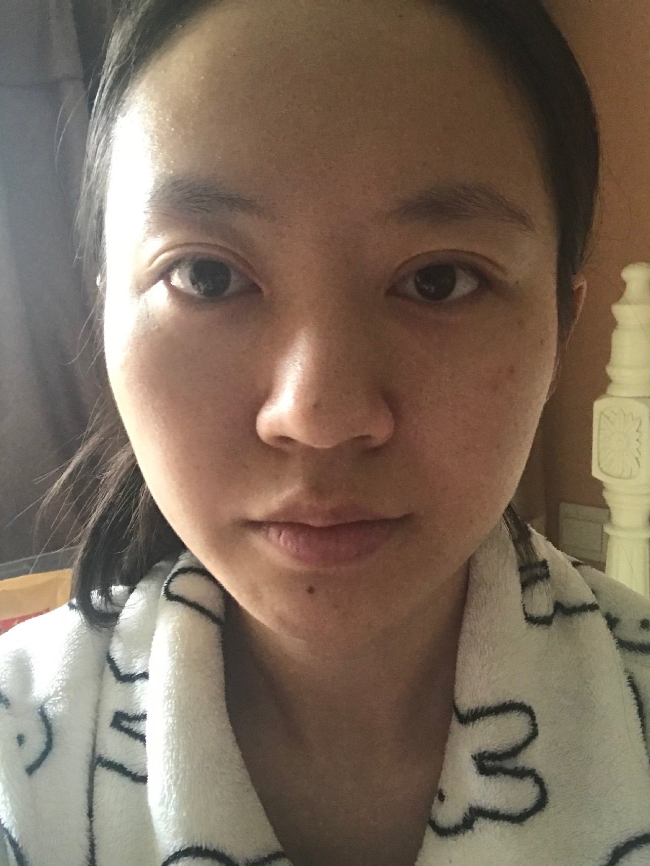 术前上睑松弛 眼球突出 上睑凹陷 不适合做很宽的双眼皮