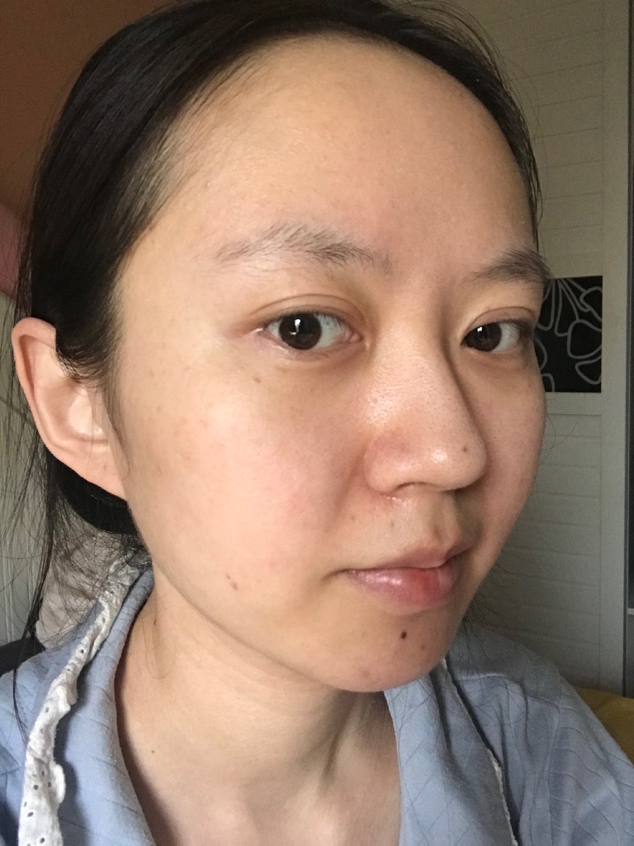 术前上睑松弛 眼球突出 上睑凹陷 不适合做很宽的双眼皮