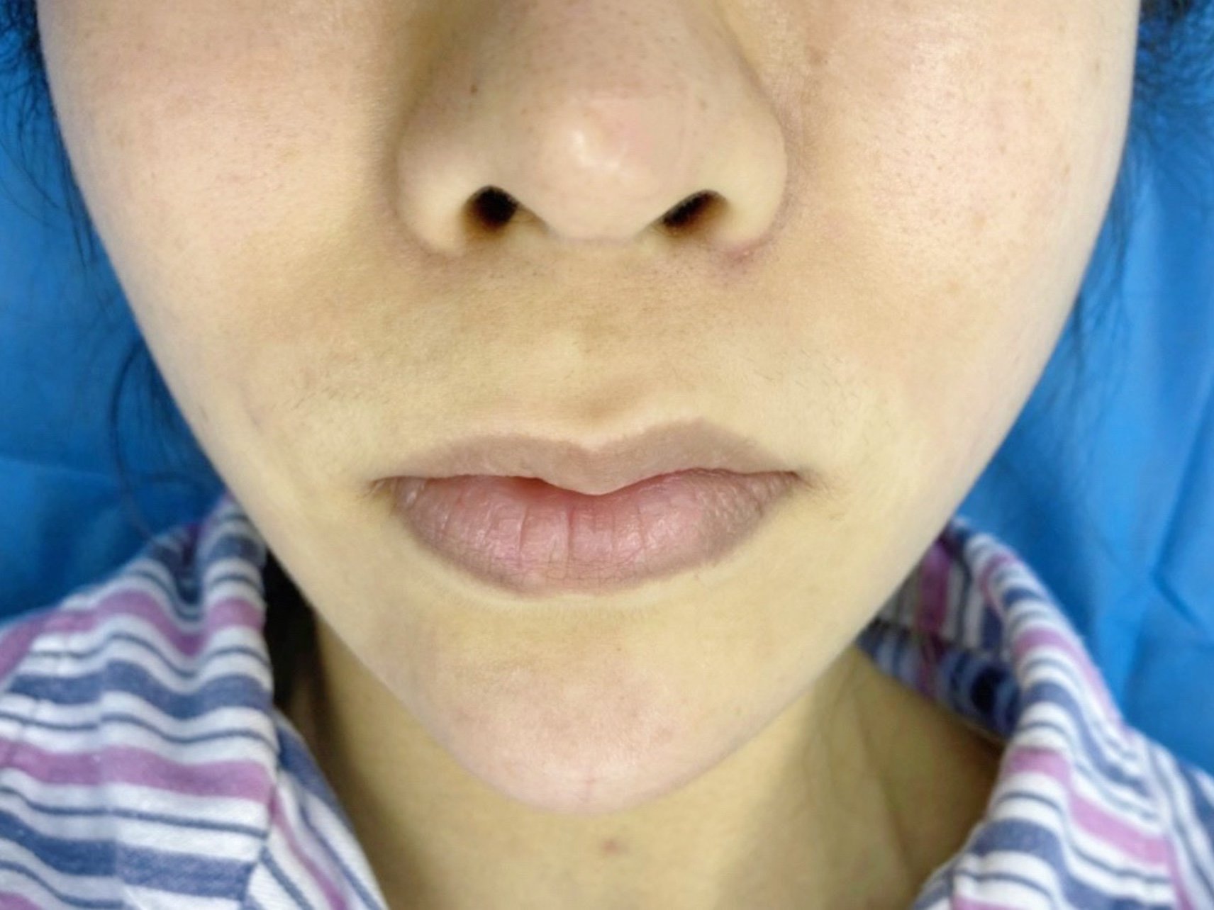 幼态短人中打造人中缩短