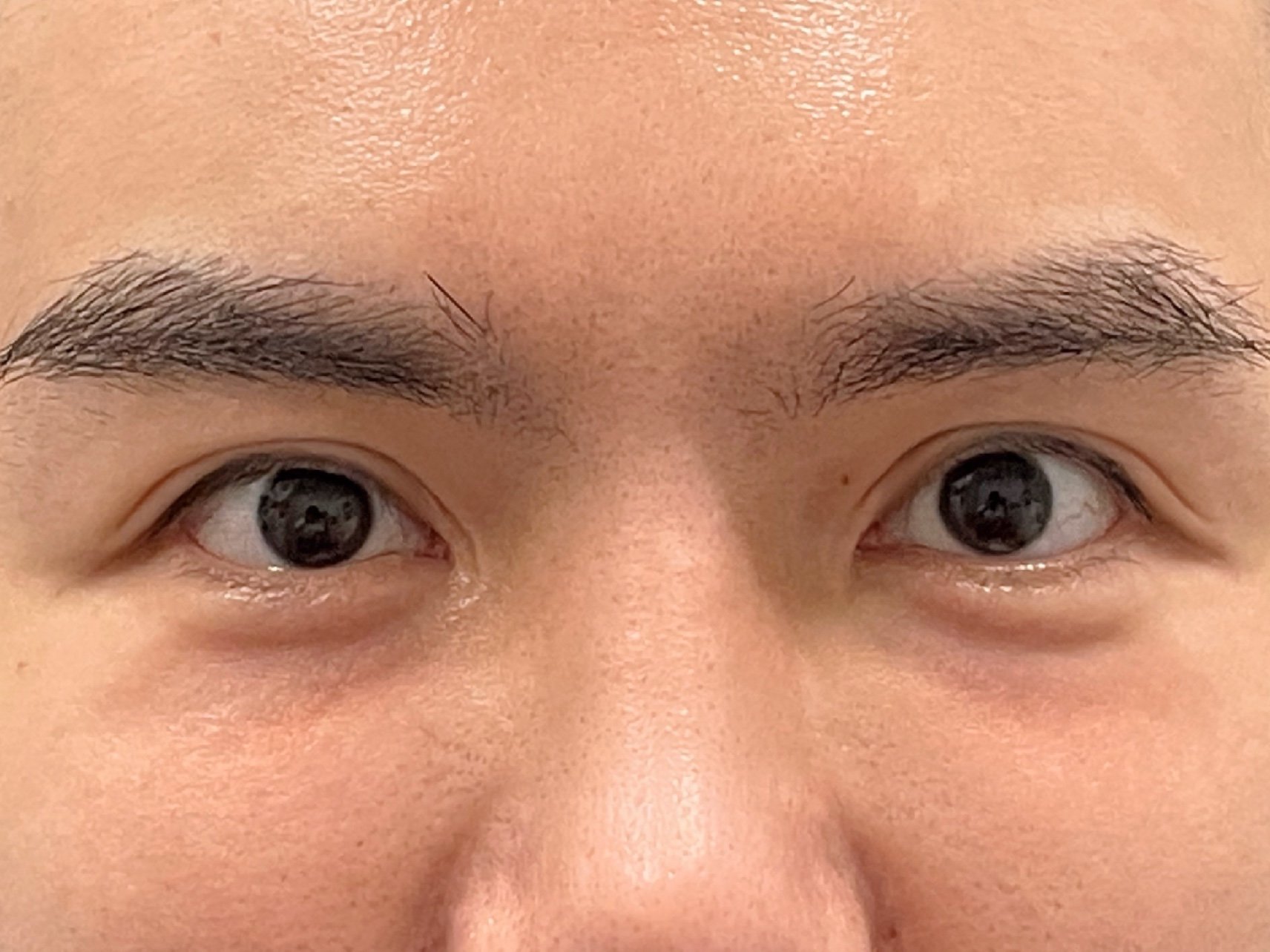 填充泪沟案例分享泪沟