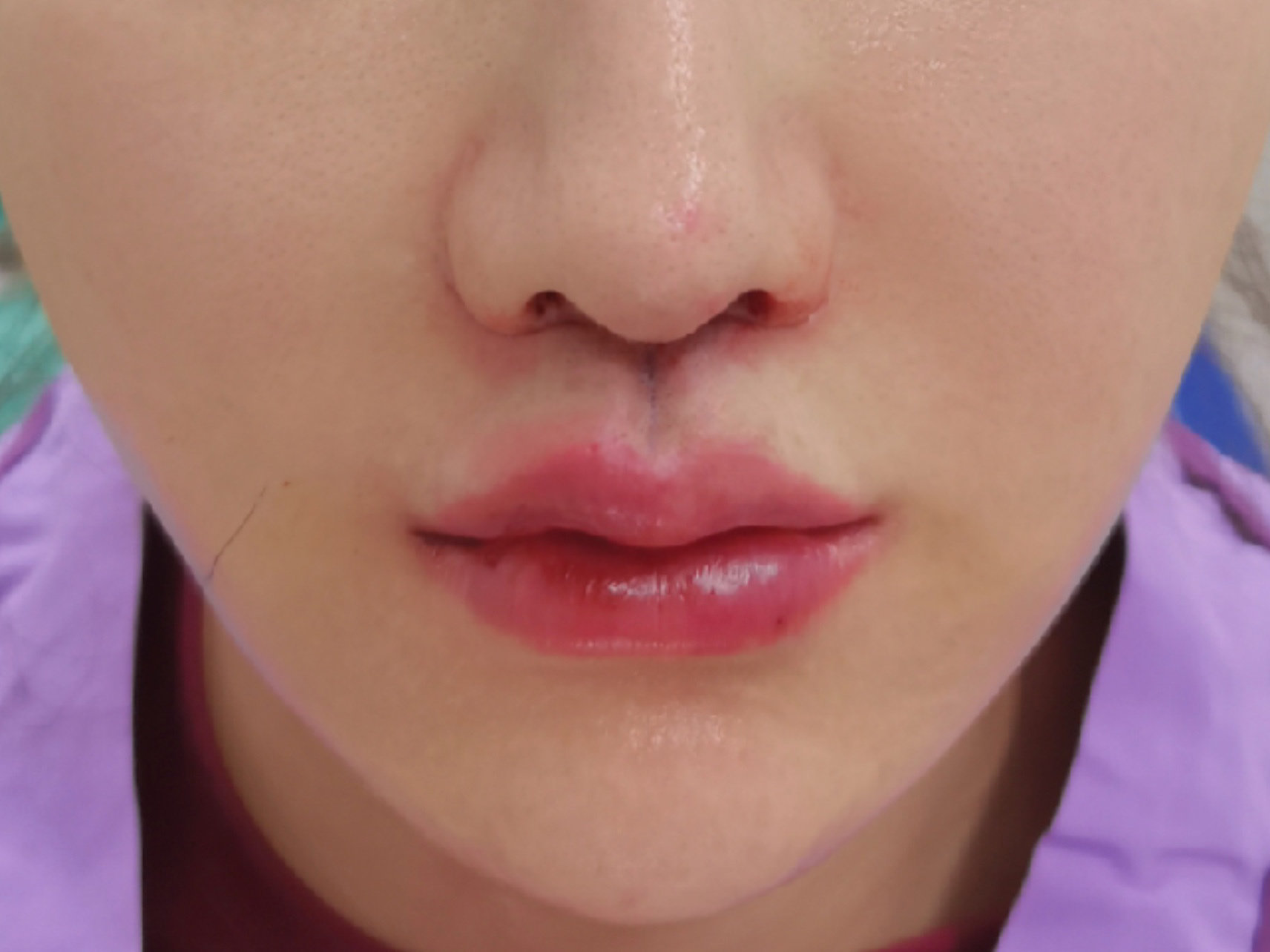 幼态短人中案例#整形医生案例大赏