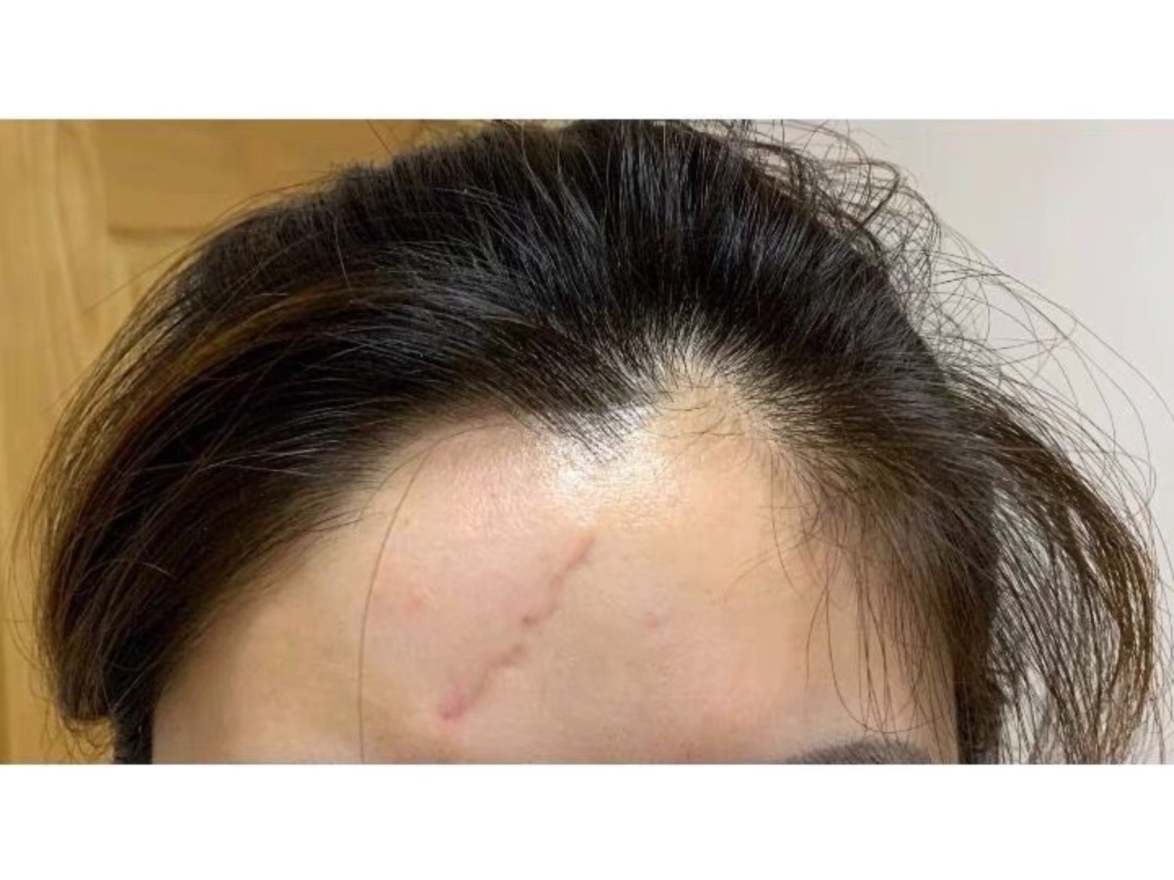 我以前听别人说什么疤痕软化针不好用啊,疤痕软化针千_圈子-新氧美容