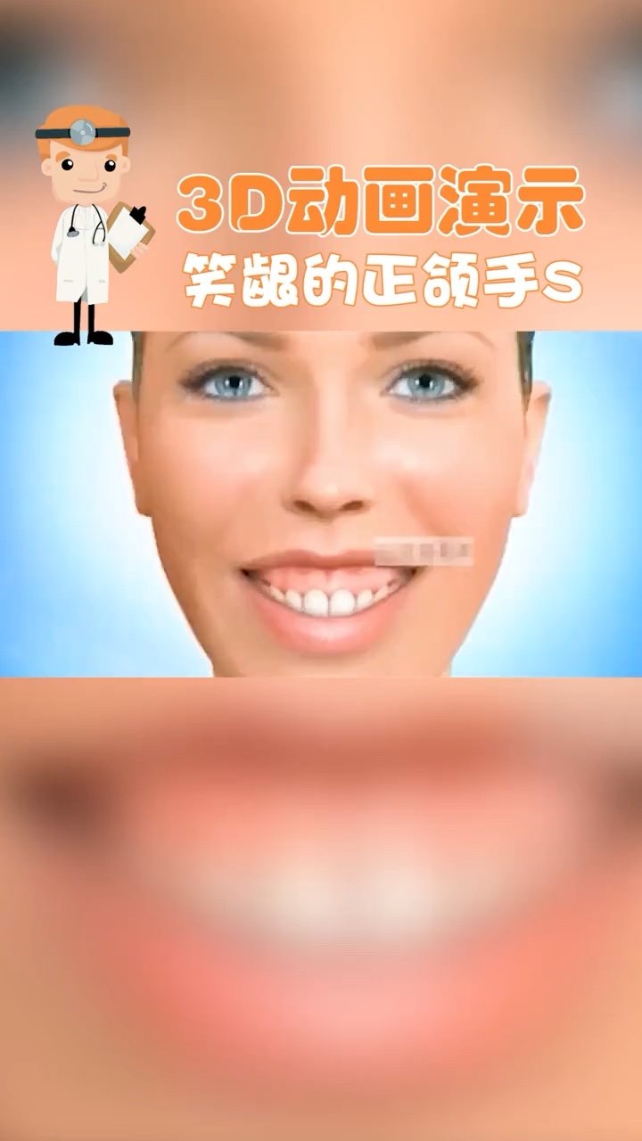 笑的时候露牙龈的矫正方式有多种