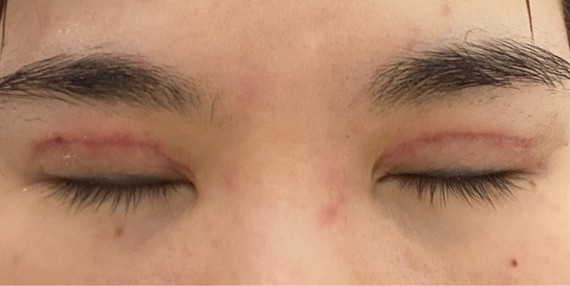 双眼皮修复手术失败