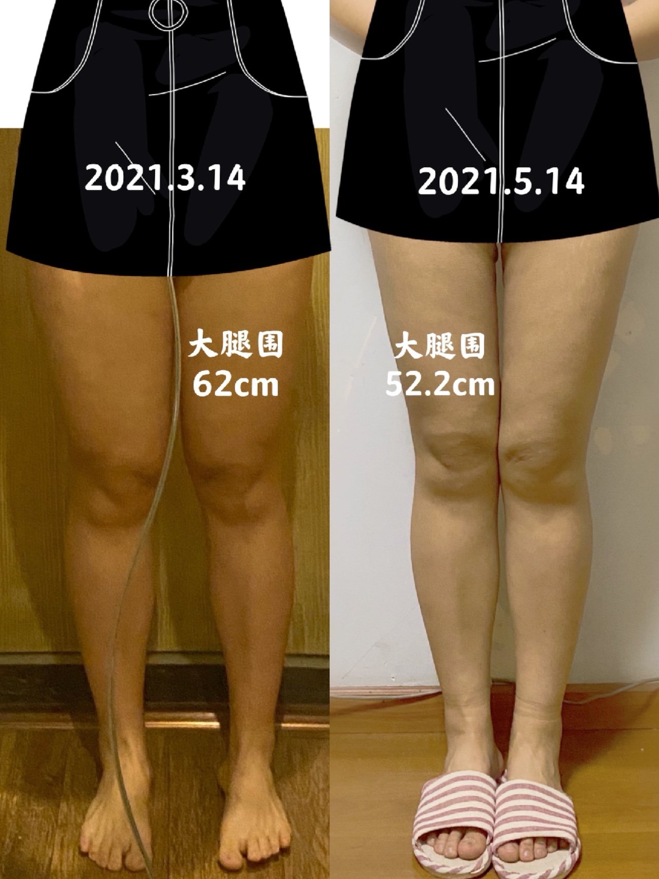 14 手术内容:黄金微雕大腿环吸 术前情况 身高:170cm 体重:70kg 大腿