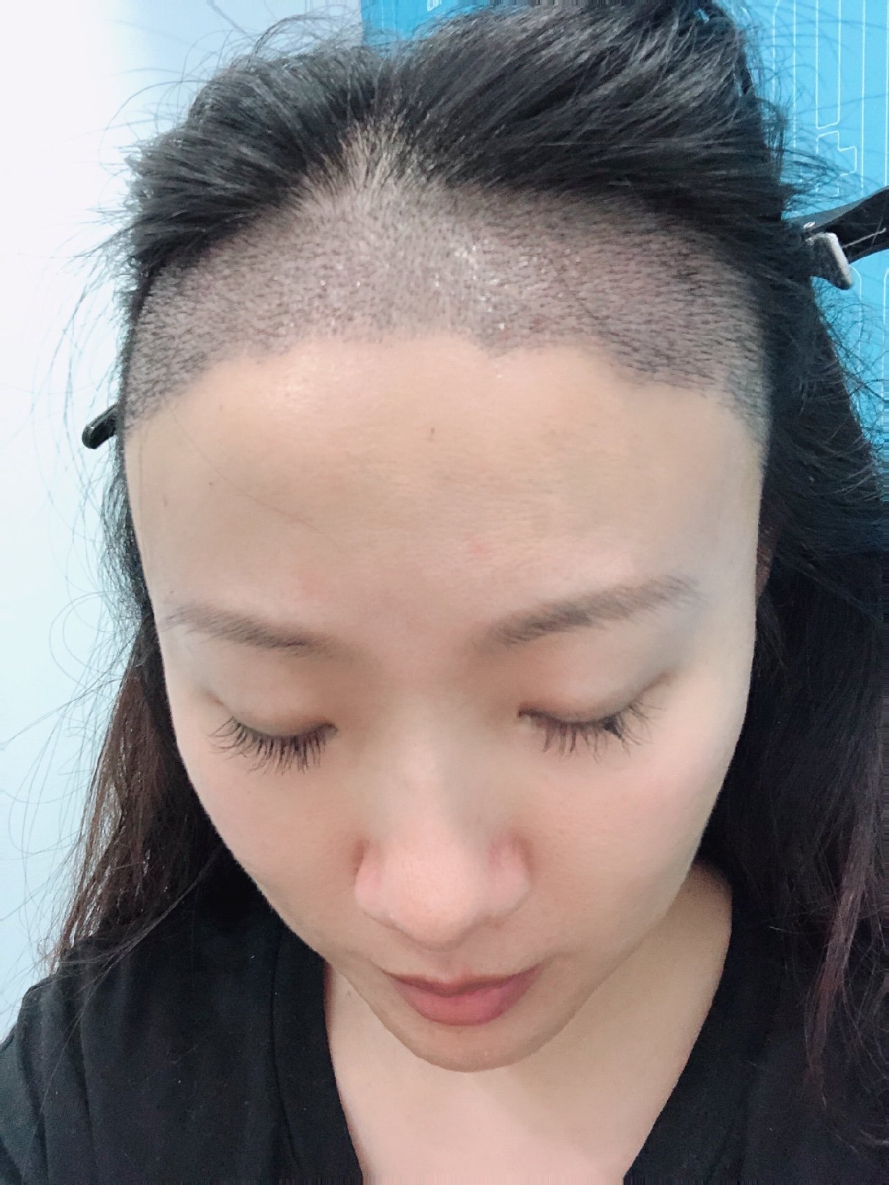 植发脸肿怎么热敷(植发脸部水肿几天可以消肿)
