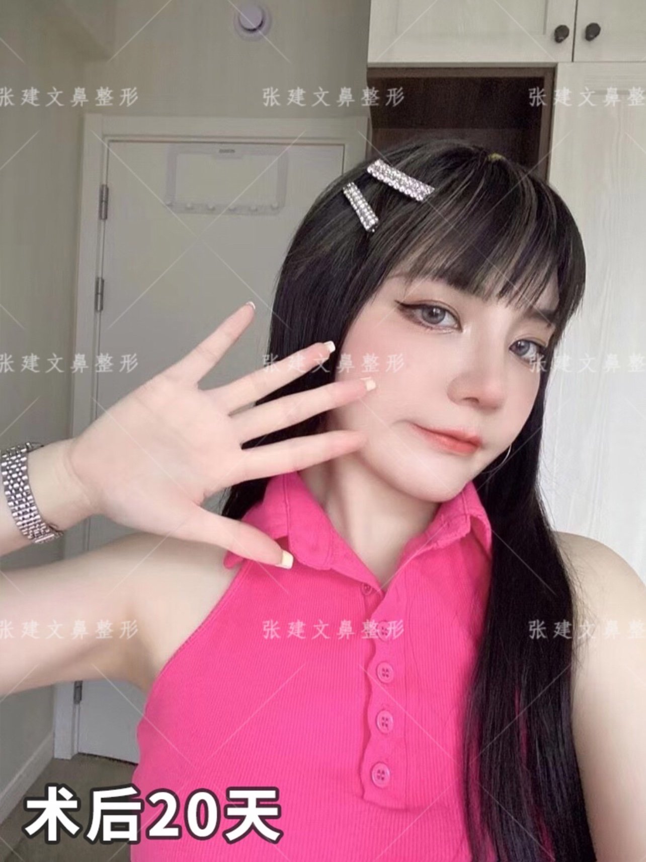 曼特波超肋隆鼻自然妈生鼻更减龄