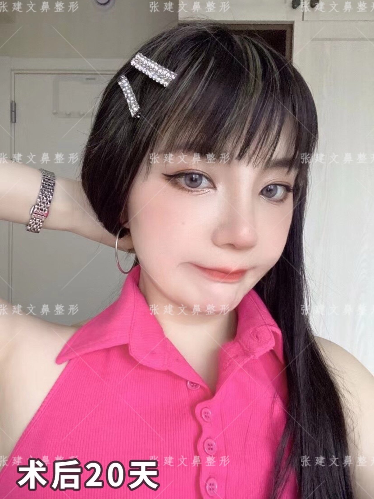 曼特波超肋隆鼻自然妈生鼻更减龄