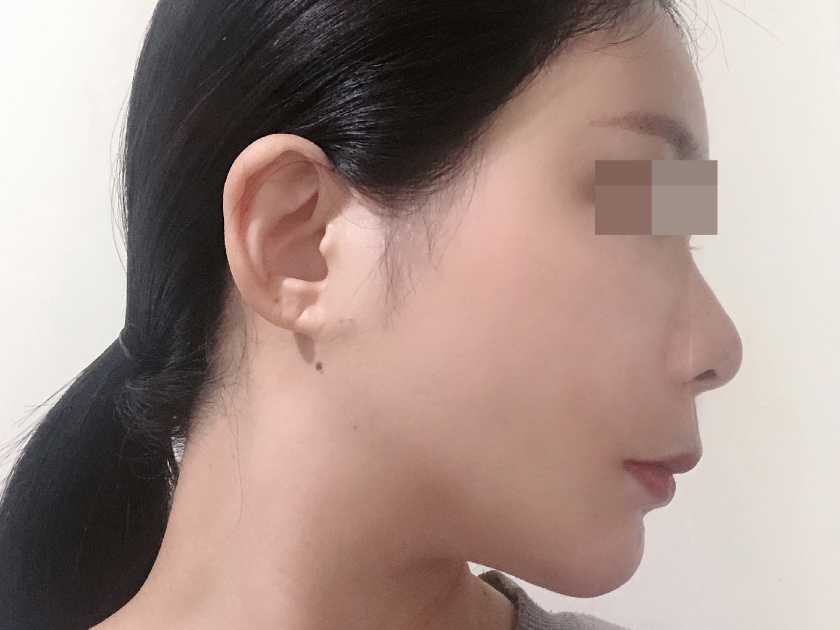 自体脂肪填充面部 光纤溶脂瘦脸下颌缘,苹果肌,面颊,手术地区:北京