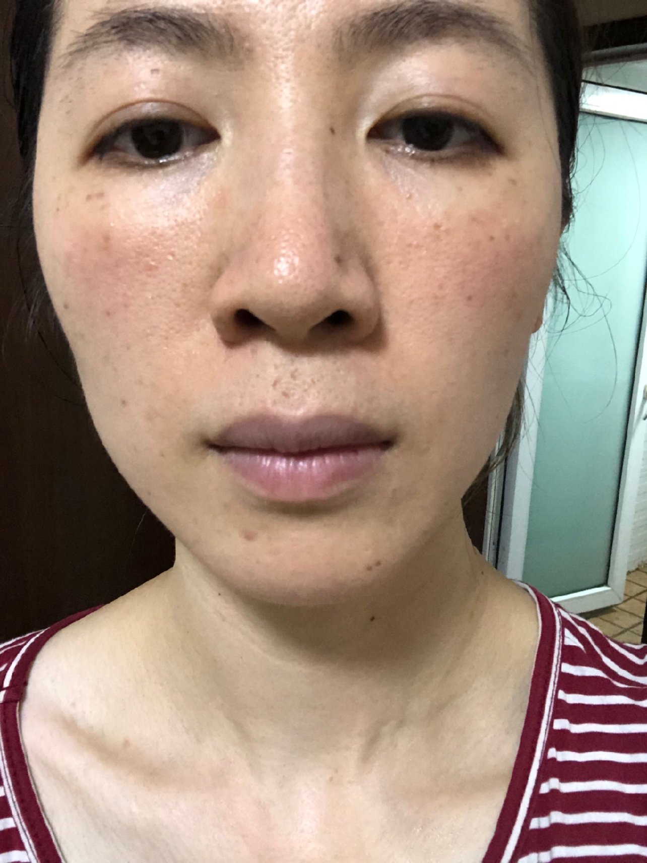 我的皮肤脸色暗沉,两颊红血丝角质层薄,下巴容易长闭口,皮肤的状态也