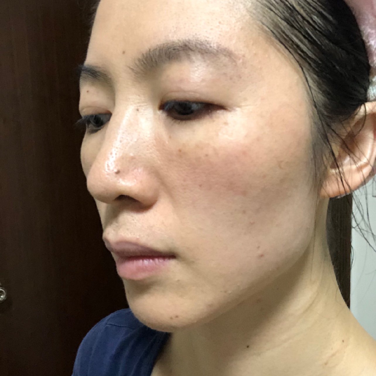 脸色暗沉,有色素沉淀,容易有闭口,特别是下巴处.