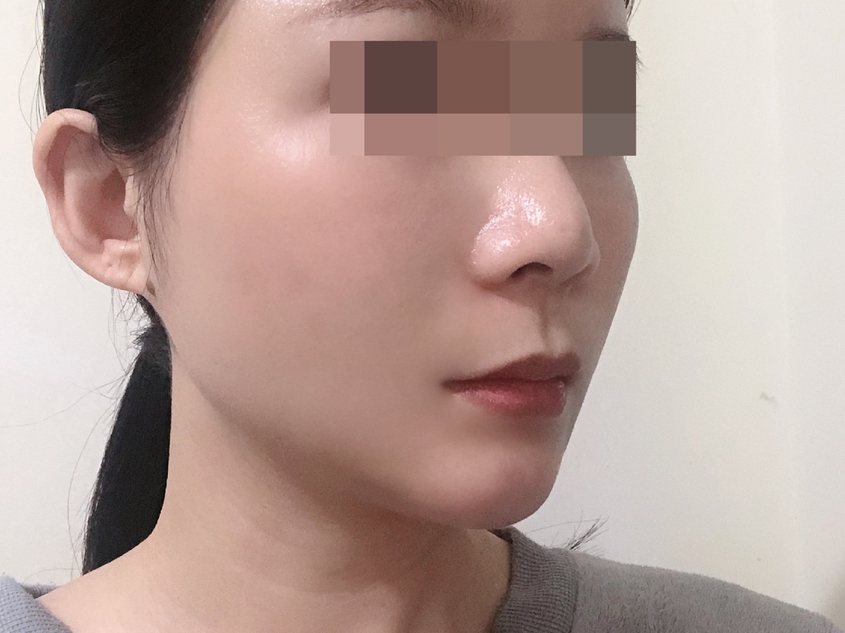 自体脂肪填充面部 光纤溶脂瘦脸下颌缘,苹果肌,面颊,手术地区:北京