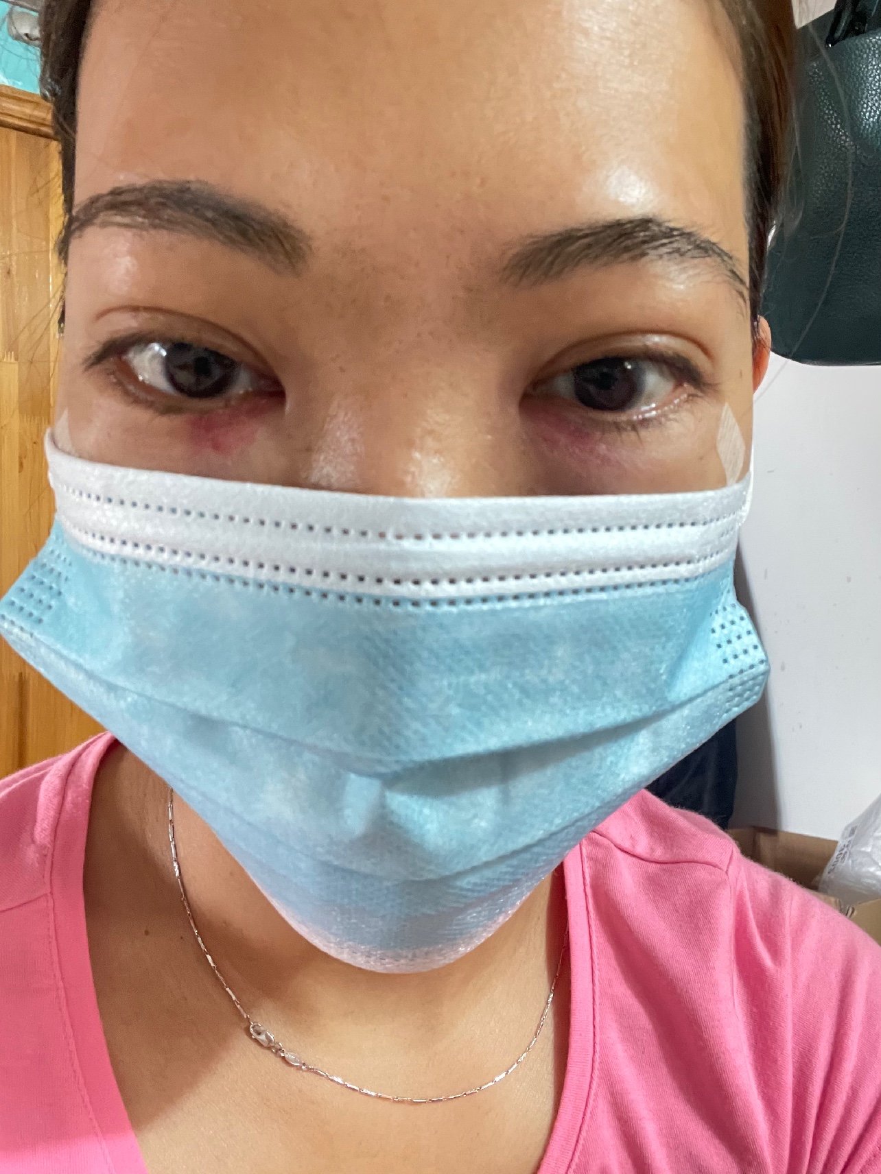 第一醒来肿没有肿到睁不开眼睛的感觉