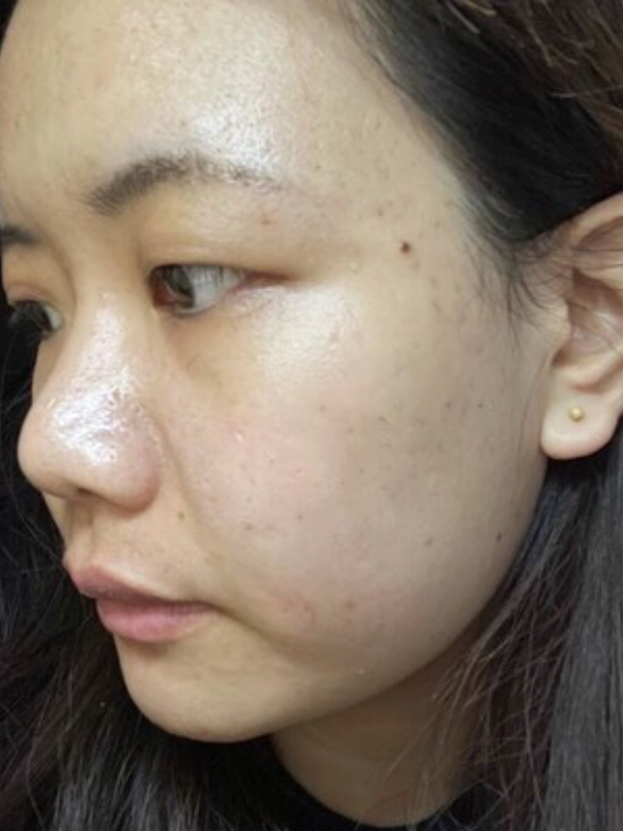 痘坑真的非常影响上妆了,每次我画完妆那个脸坑坑洼洼_圈子-新氧美容