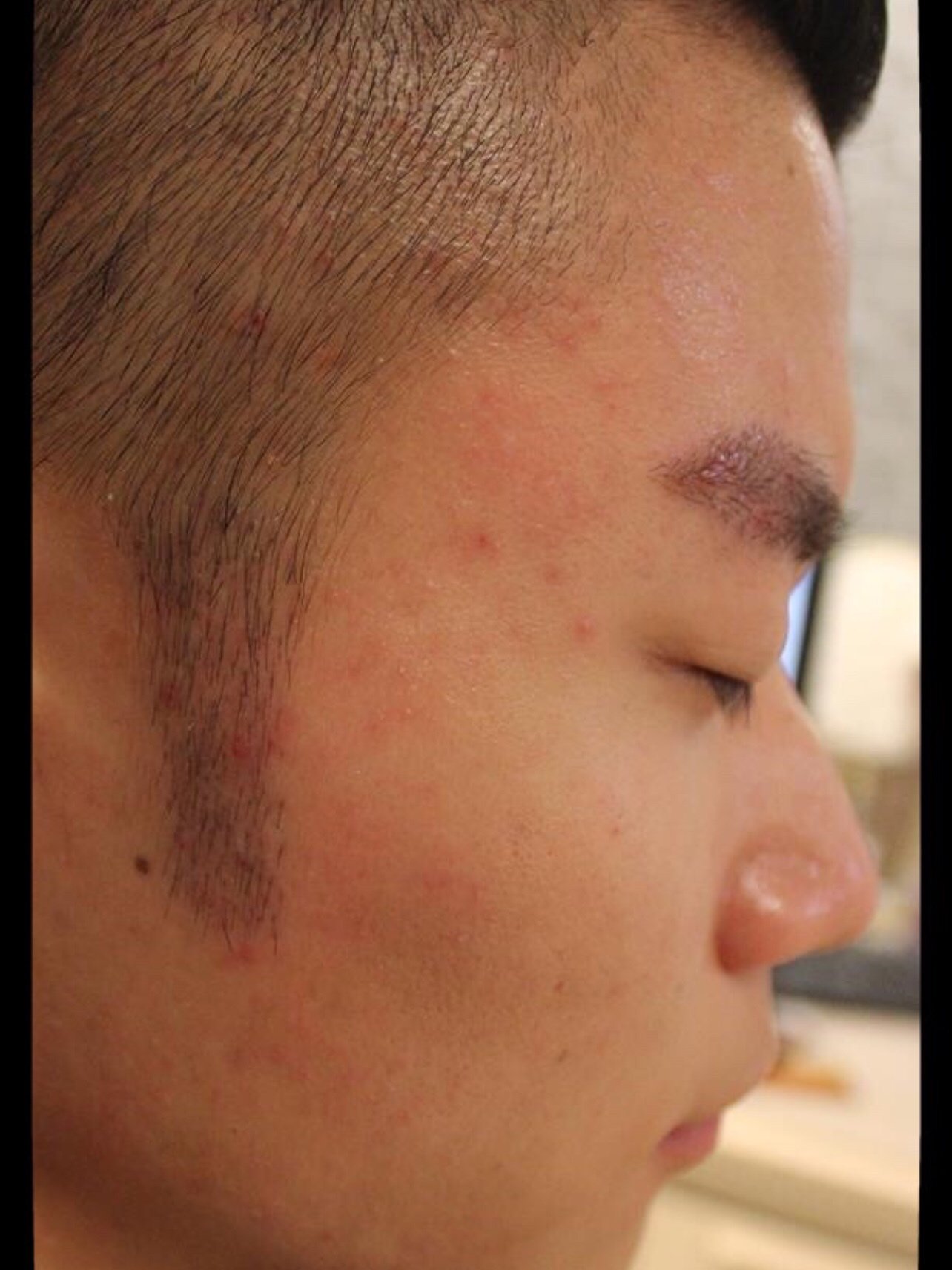 一般人都有鬓角的,我偏偏是那个没有鬓角的人,自己也_圈子-新氧美容