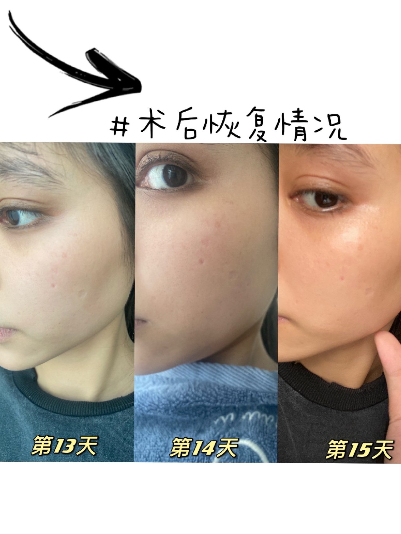 今天是【半岛黄金微针】7015【英诺去黑素】的术后两周_圈子-新氧