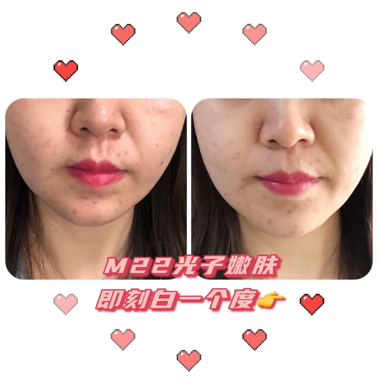 光子嫩肤术后第2天第1篇日记即刻效果#新氧试用官m_圈子-新氧美容整形