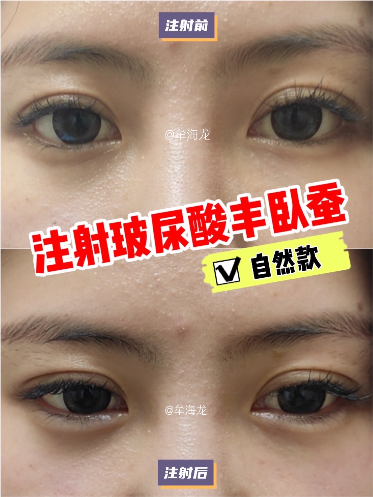 注射玻尿酸丰卧蚕填充后即刻对比