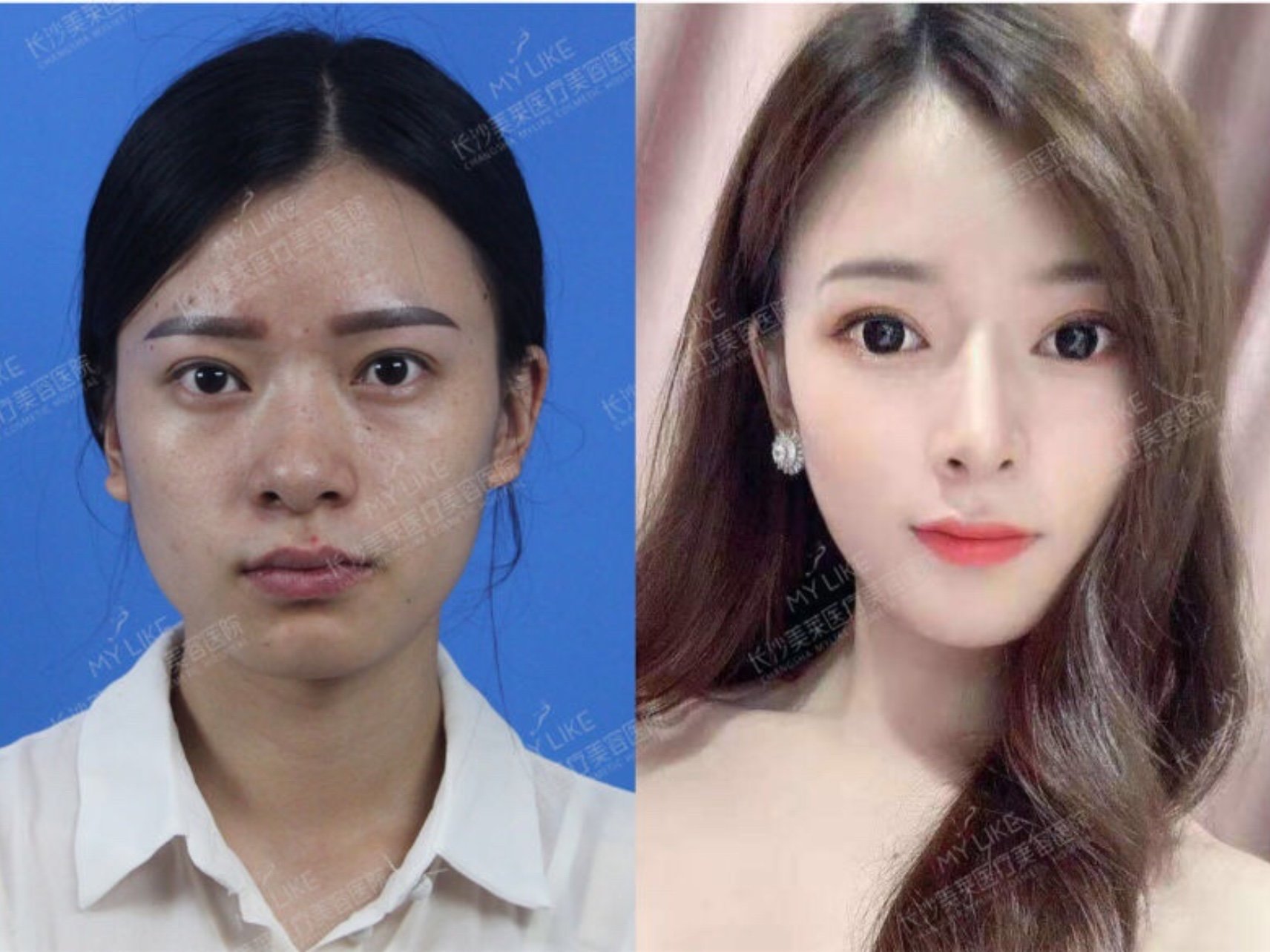 术前鼻中凹陷,鼻小柱后缩,鼻头圆润,很不协调,肉感_圈子-新氧美容整形