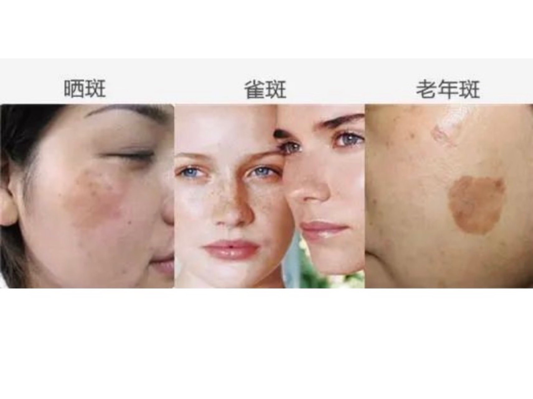 近几年皮秒激光作为一种能祛斑嫩肤的美容靓肤神器让许多爱美的女性趋
