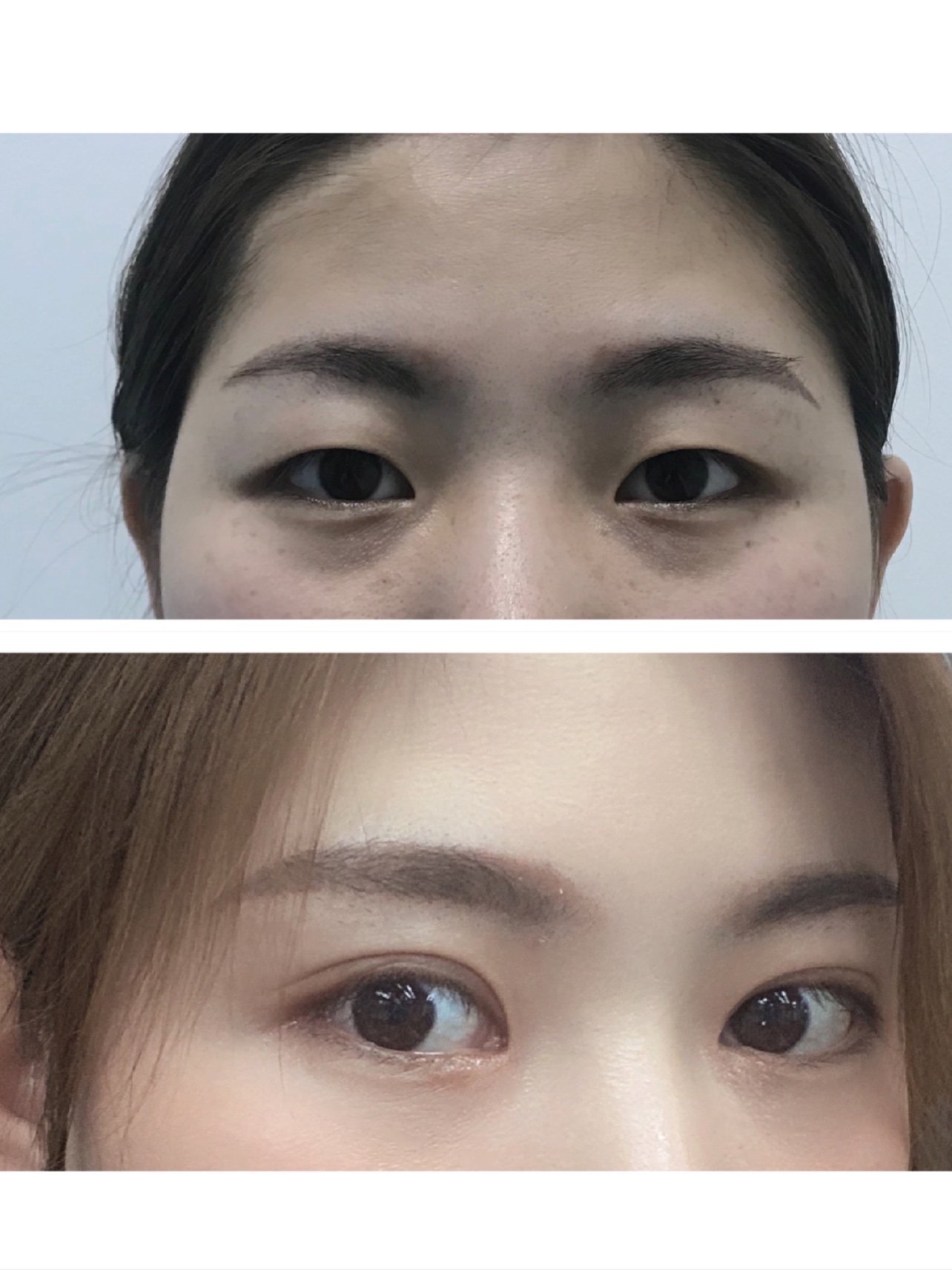 天生单眼皮,有内眦赘皮的存在.