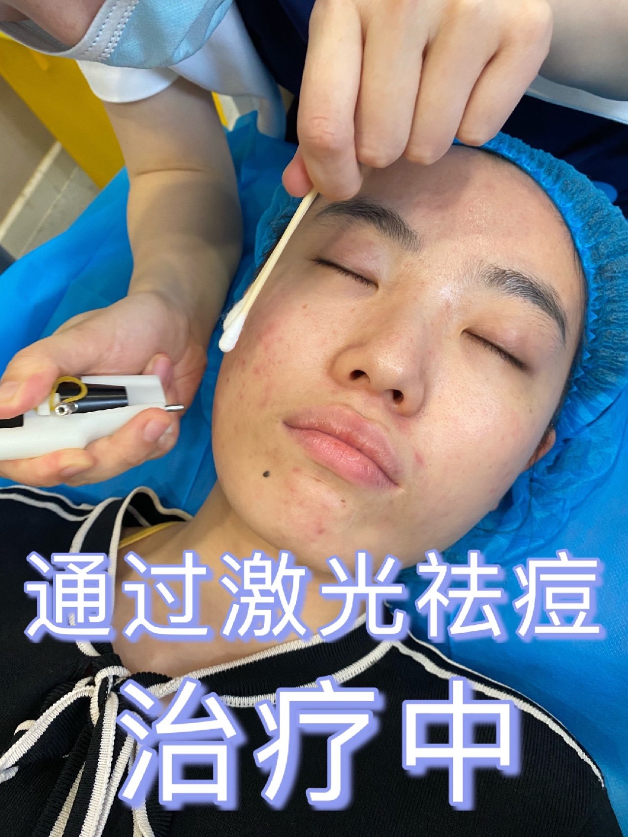 因为太多痘痘了很烦恼!非常想要这次通过激光来帮助我战胜痘痘!