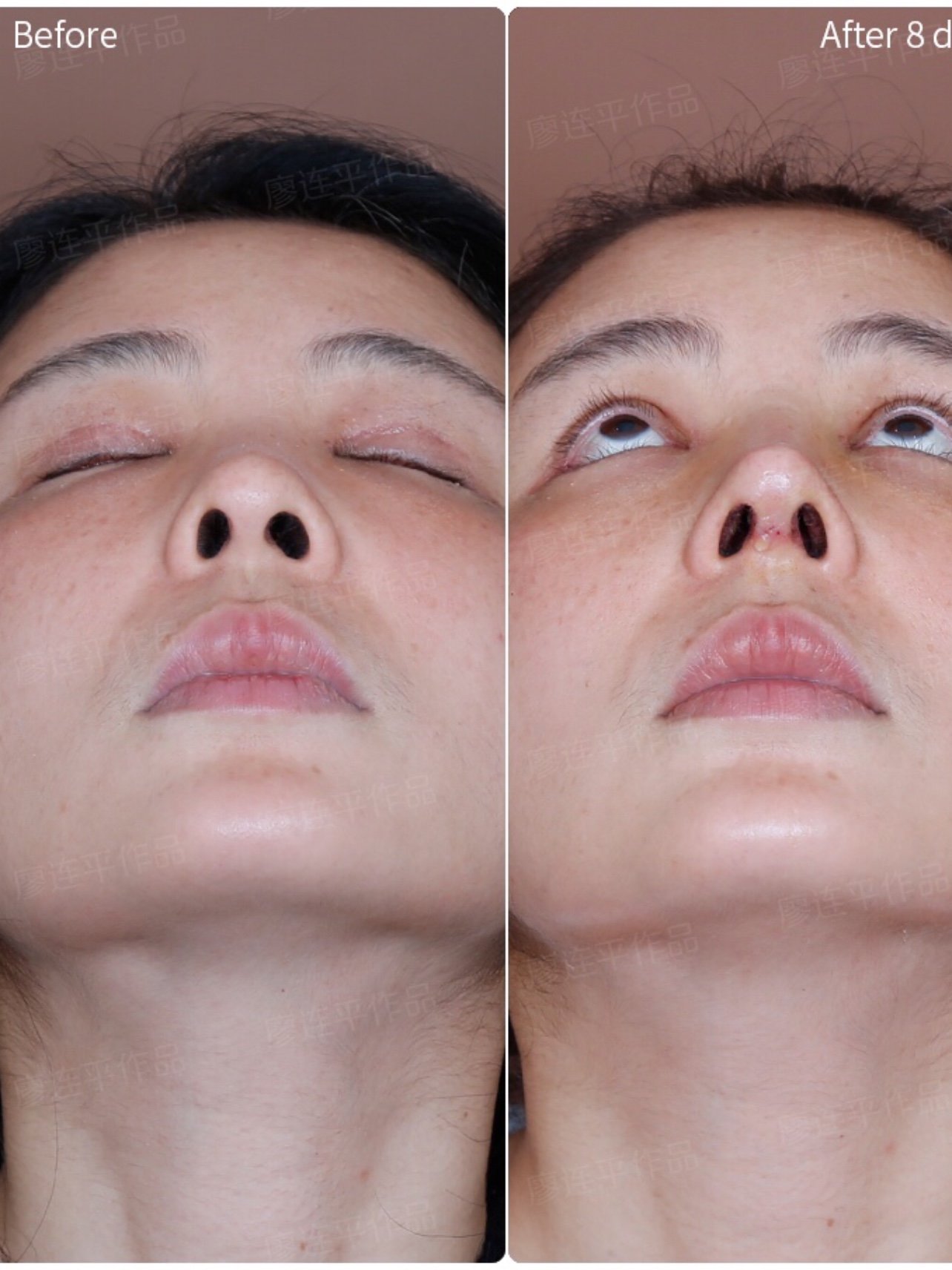 露鼻孔,歪鼻矫正,2次肋骨鼻修复案例分享