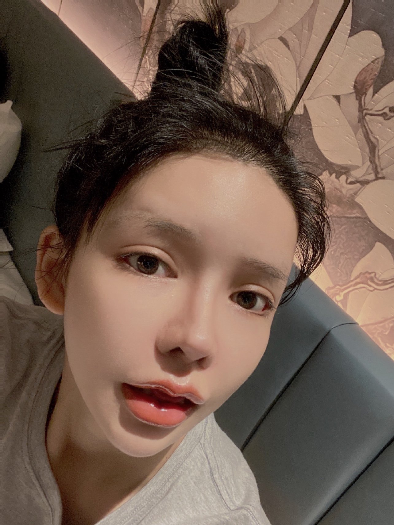 北京微美玻尿酸丰唇第4天93医生:余若晖91手术项目:_圈子-新氧