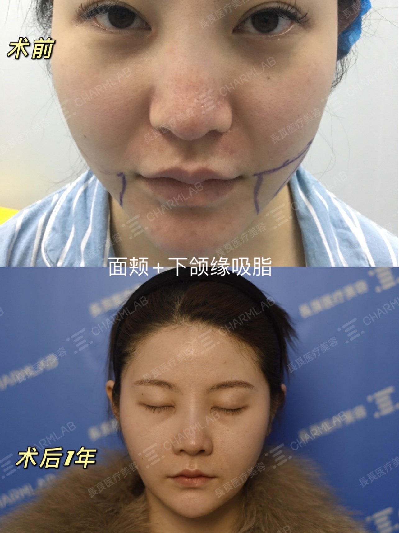 下颌缘 面颊 嘟嘟肉吸脂