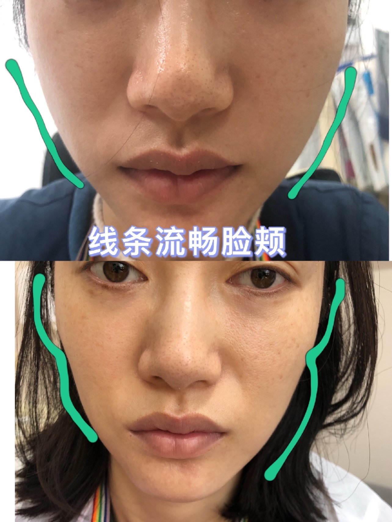 玻尿酸填充面颊day5