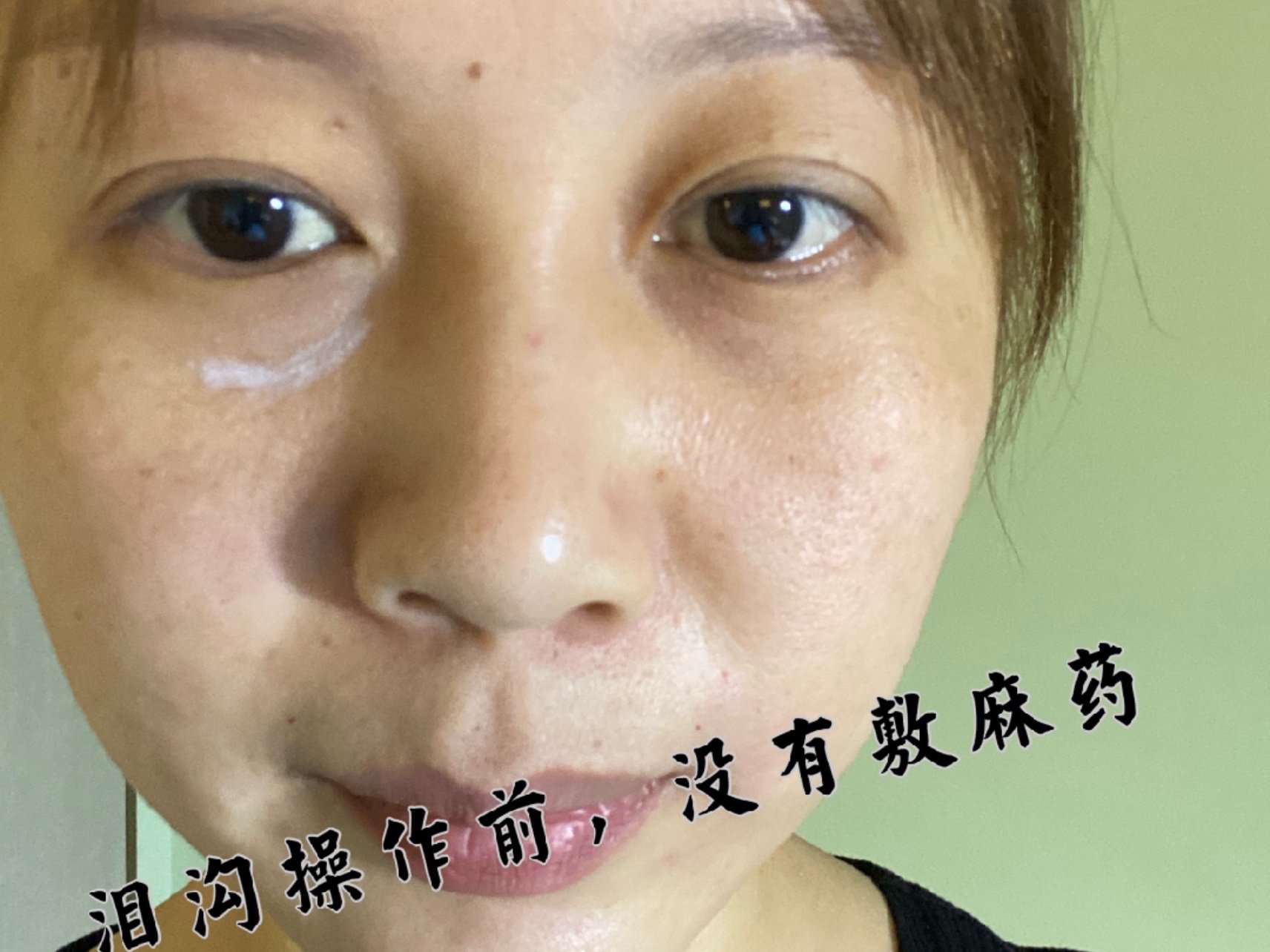 上次和大家分享了玻尿酸填充泪沟的效果,是非常满意的_圈子-新氧美容