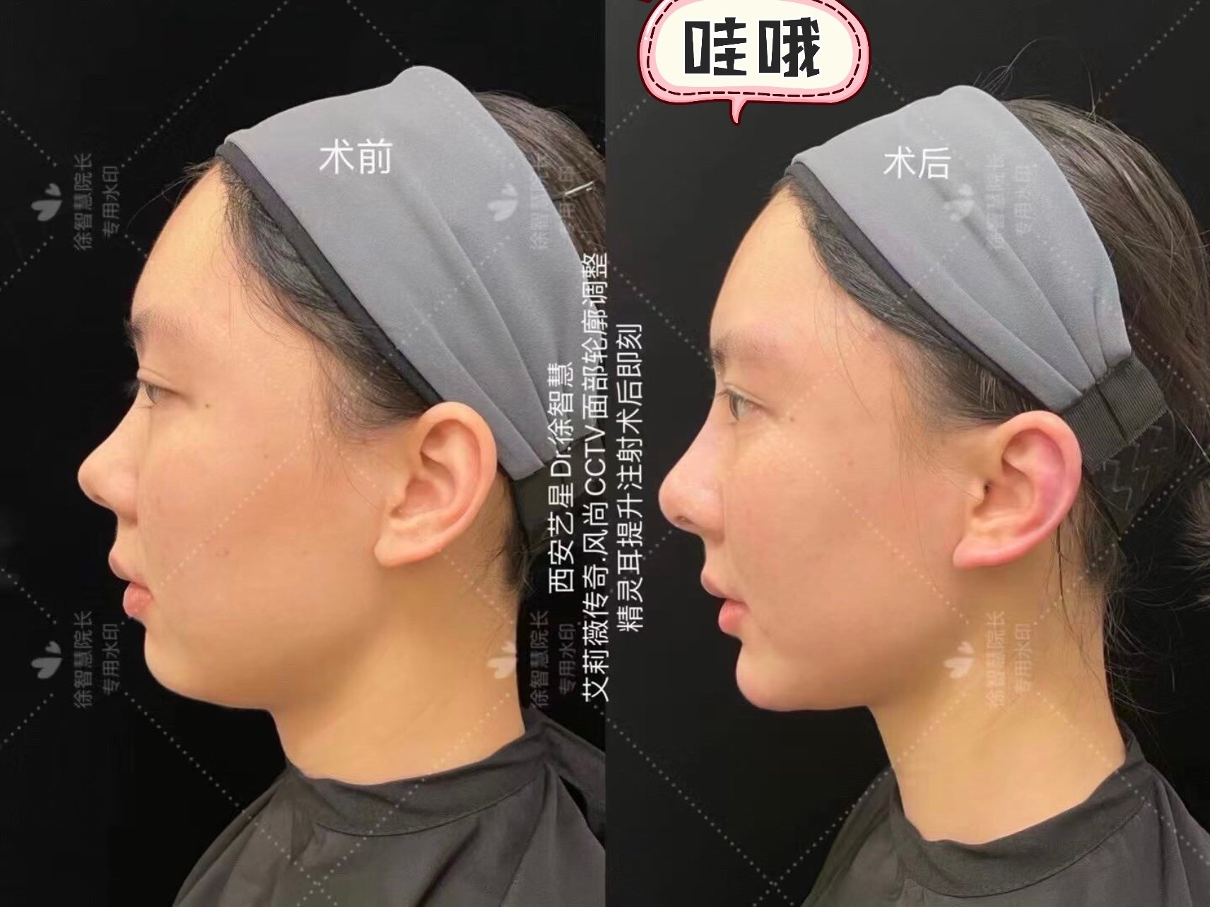 杀手99精灵耳注射完美诠释轻奢美容73732_圈子-新氧美容整形