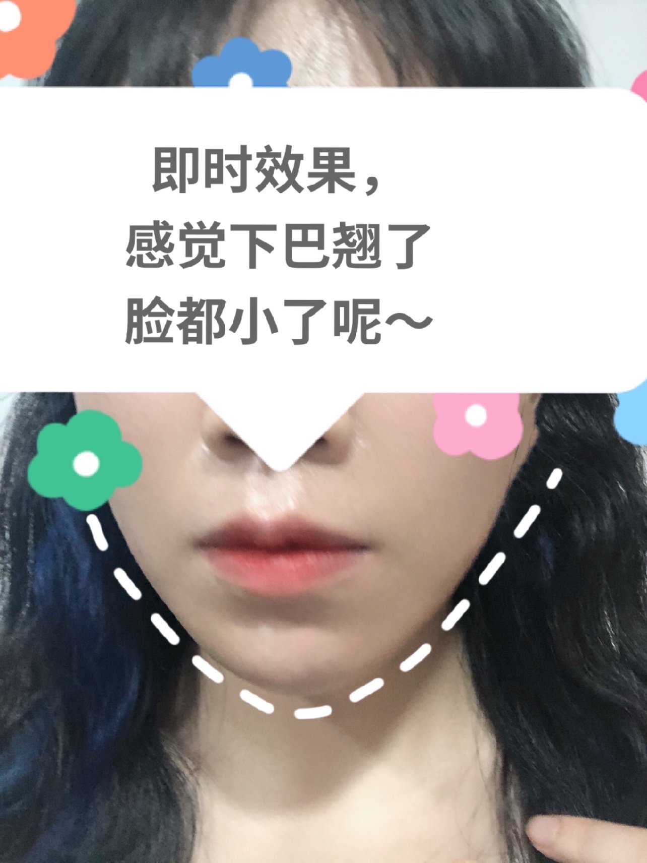 婕尔玻尿酸翘下巴体验第一天来啦