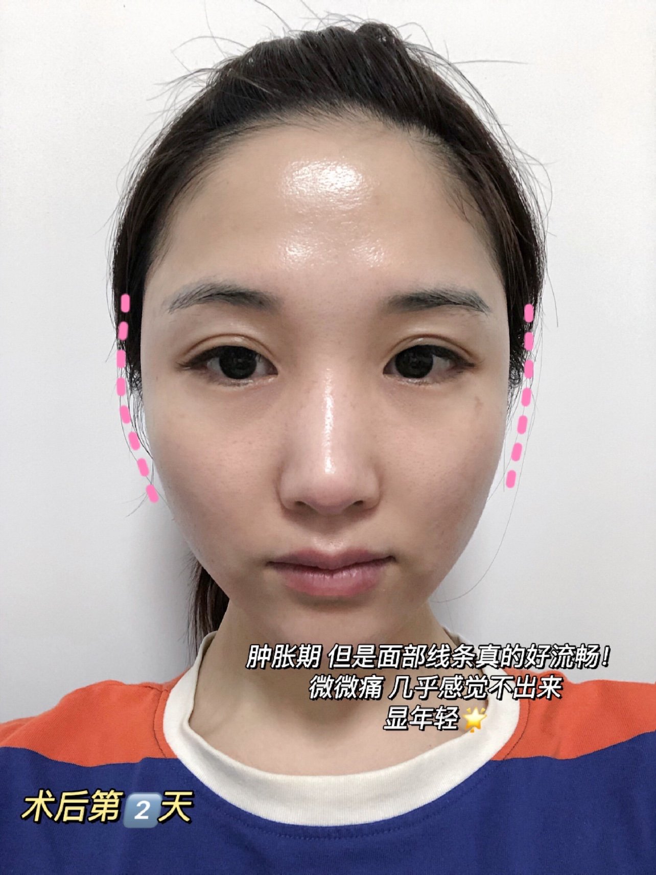 婕尔玻尿酸78填充太阳穴术后一周记录
