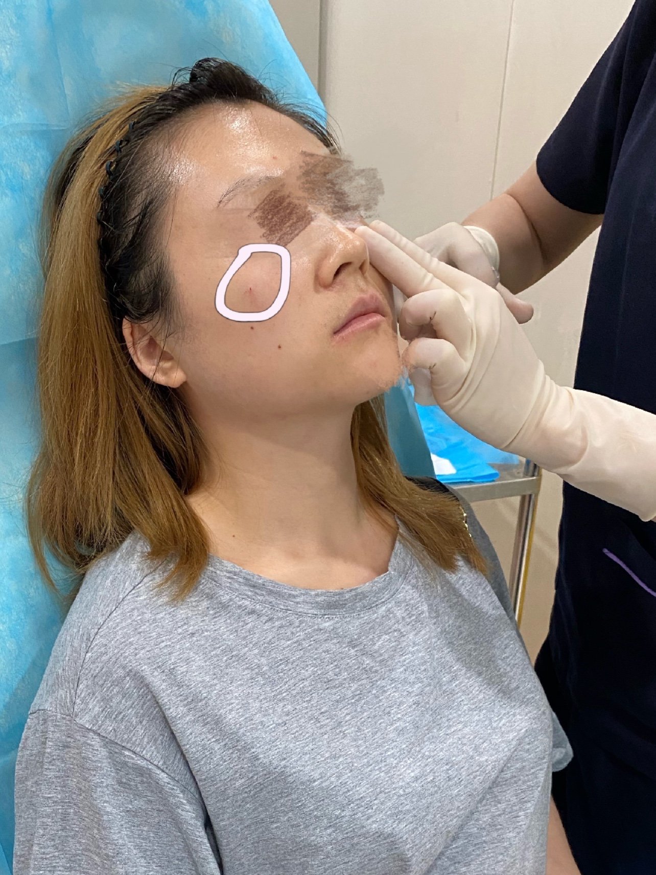 婕尔玻尿酸注射苹果肌已经7天了